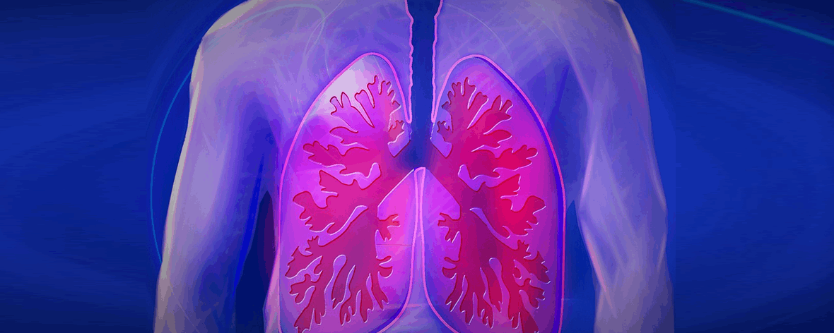 Przewlekła obturacyjna choroba płuc (POChP)